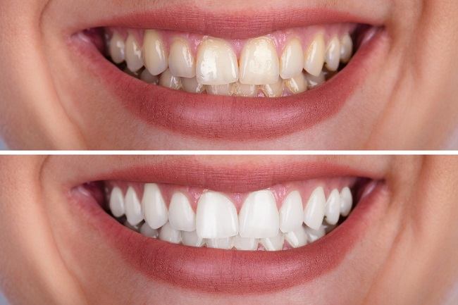 Diverse moduri de a depăși dinții galbeni la dentist