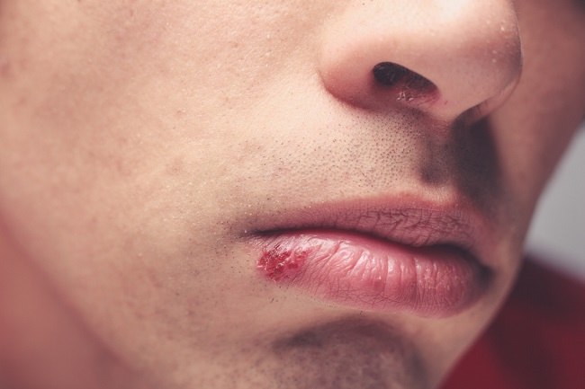 입술과 입의 헤르페스 인식 및 극복 방법