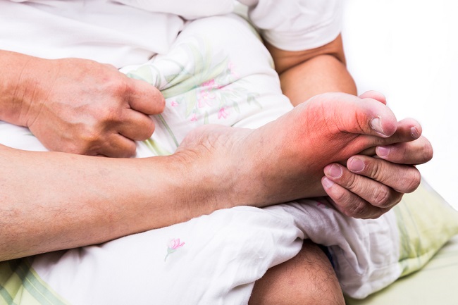 Simptomi gihta u stopalima koje je važno prepoznati