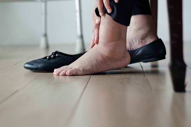 발이 붓는 원인과 쉽게 극복할 수 있는 방법