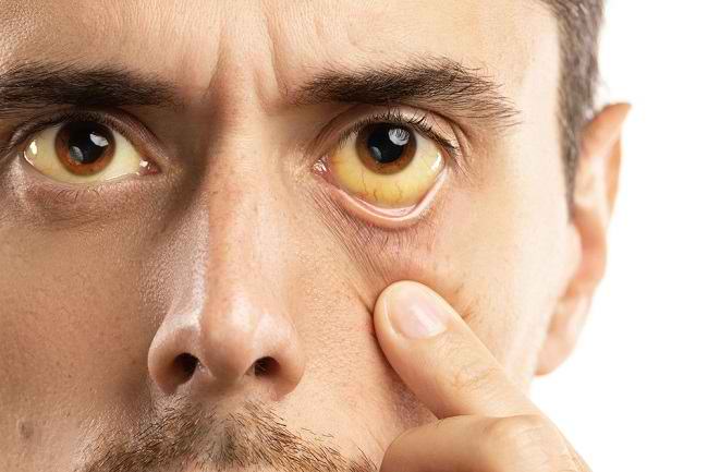 가볍게 생각하지 마세요. 주의해야 할 노란 눈의 5가지 원인