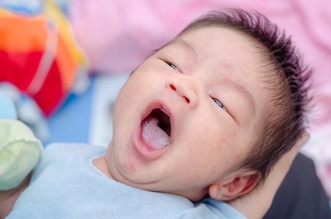 아기의 흰 혀와 치료 방법