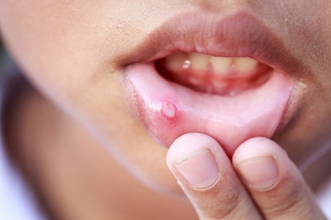 입술의 구내염은 여러 가지 원인으로 인해 발생할 수 있습니다.