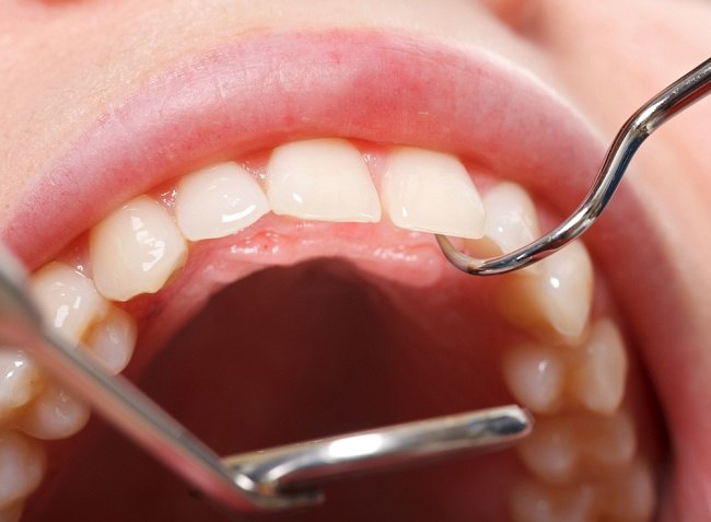 Enkelt och praktiskt, det här är 5 sätt att ta bort plack på tänderna