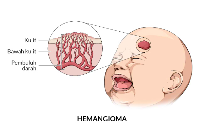 Hemangiom