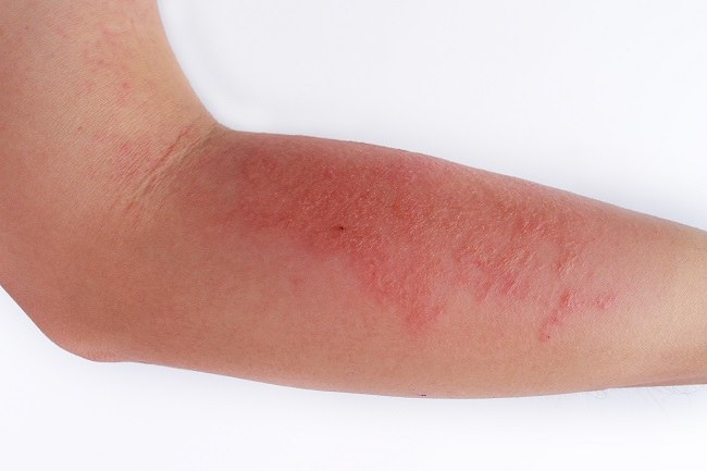 Behandling av atopisk dermatit och hur man kontrollerar dess symtom