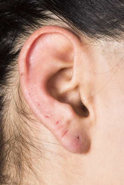 귀에 형성되는 작은 구멍인 전구동(Preauricular Sinus) 이해하기