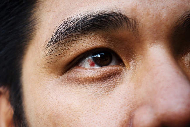 결막과 눈 주위의 이물질 침입을 극복하는 방법