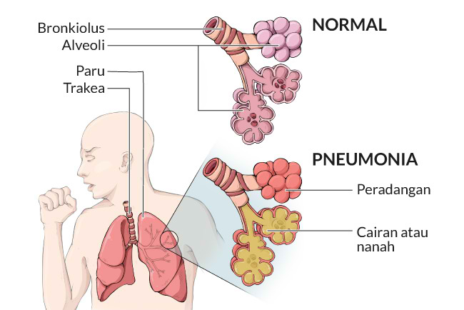 הגדרה של דלקת ריאות